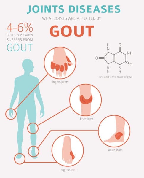 Vitamin C and Gout infographic on where gout affects body