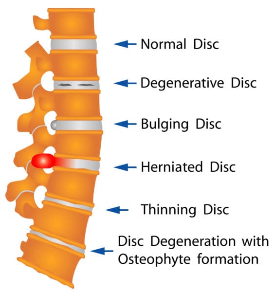 Clevive™ Degenerative Disc Disease Cushion – Clevive