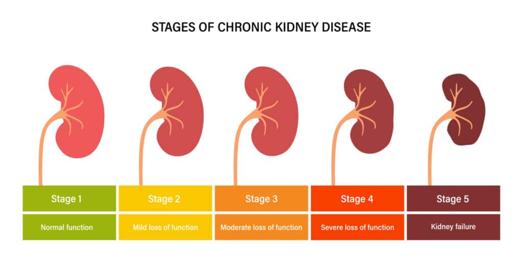 How Chronic Kidney Disease Develops: The Stages