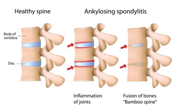 what is Ankylosing spondylitis