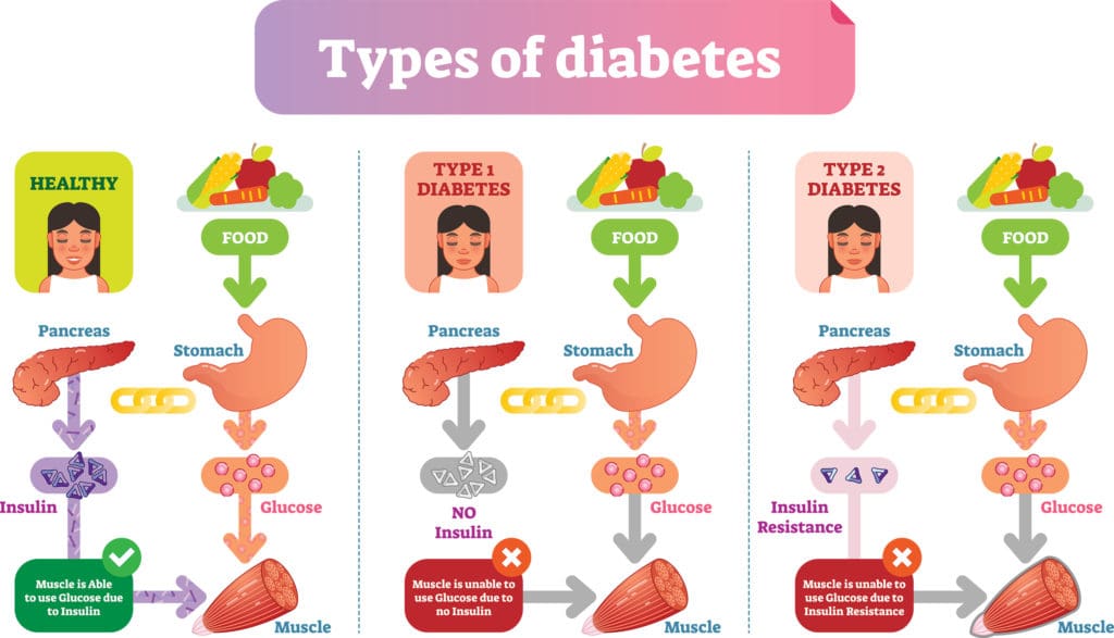 three major types of diabetes