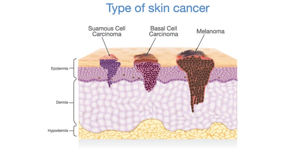types of skin cancer infographic
