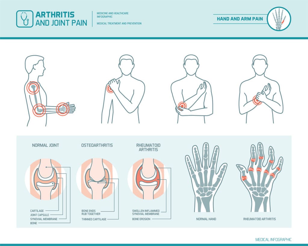 what is arthritis chart